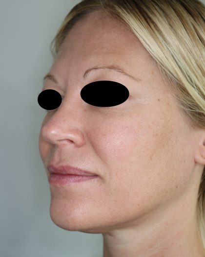 Hautunterspritzungen Before & After Patient #2252