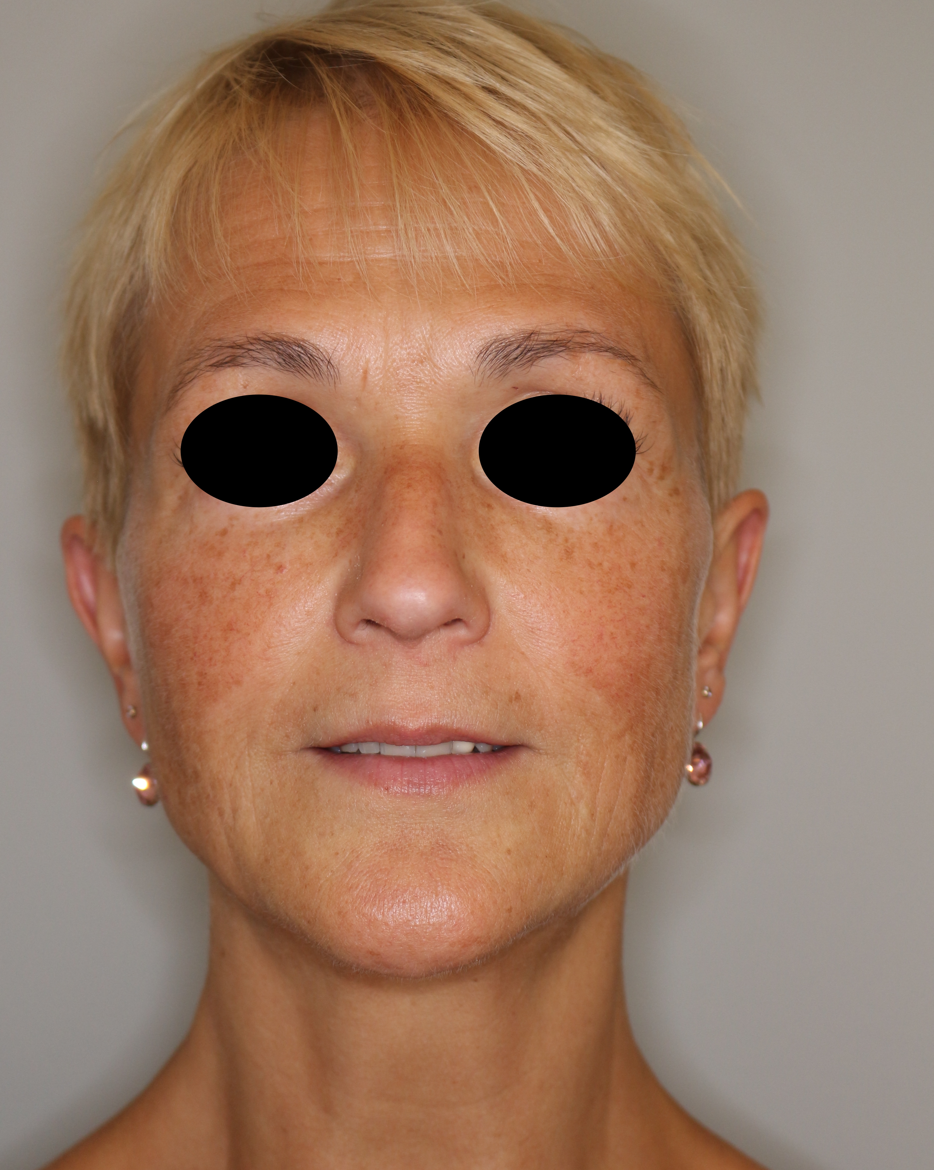 Faltenbehandlung Before & After Patient #2206