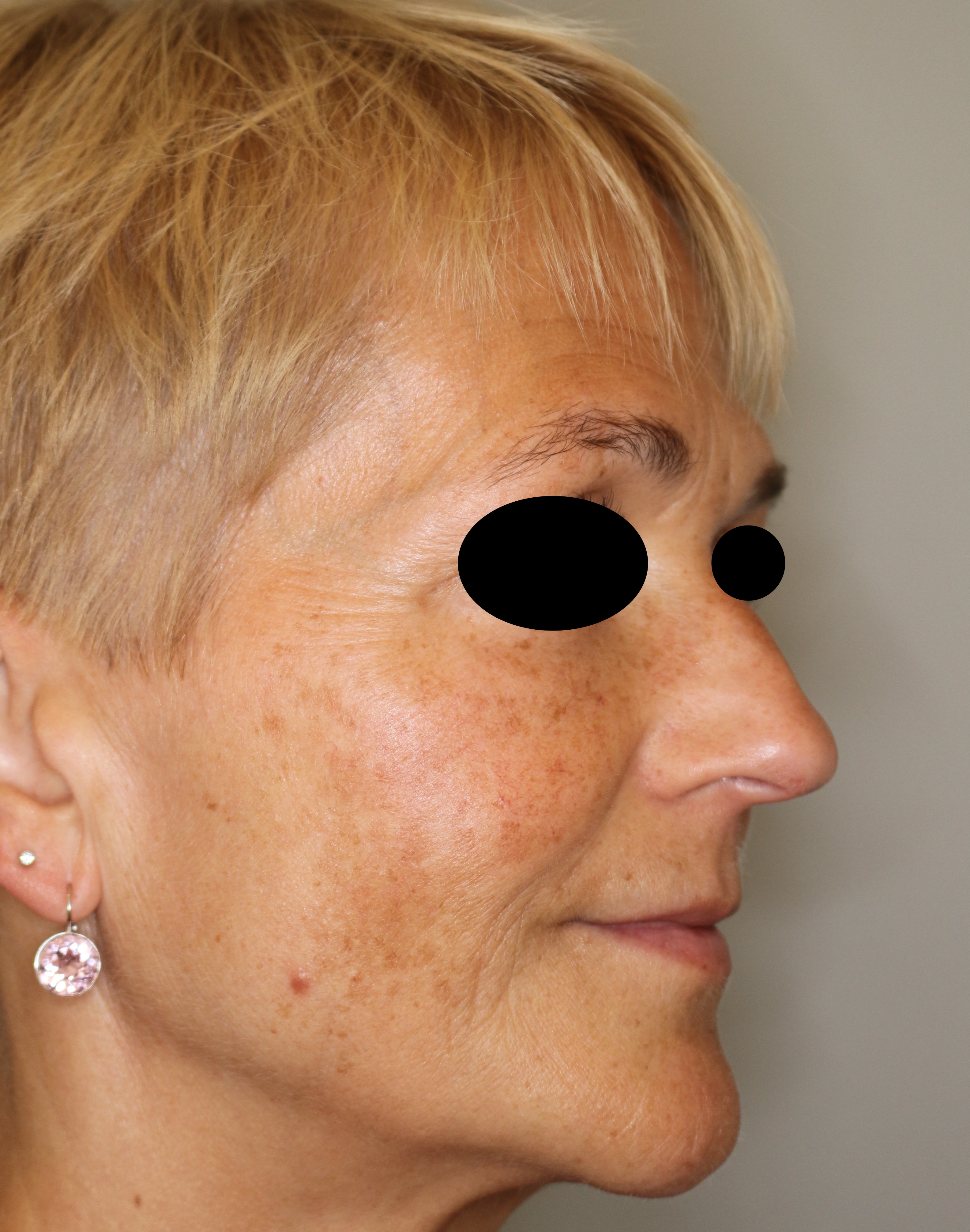 Faltenbehandlung Before & After Patient #2206