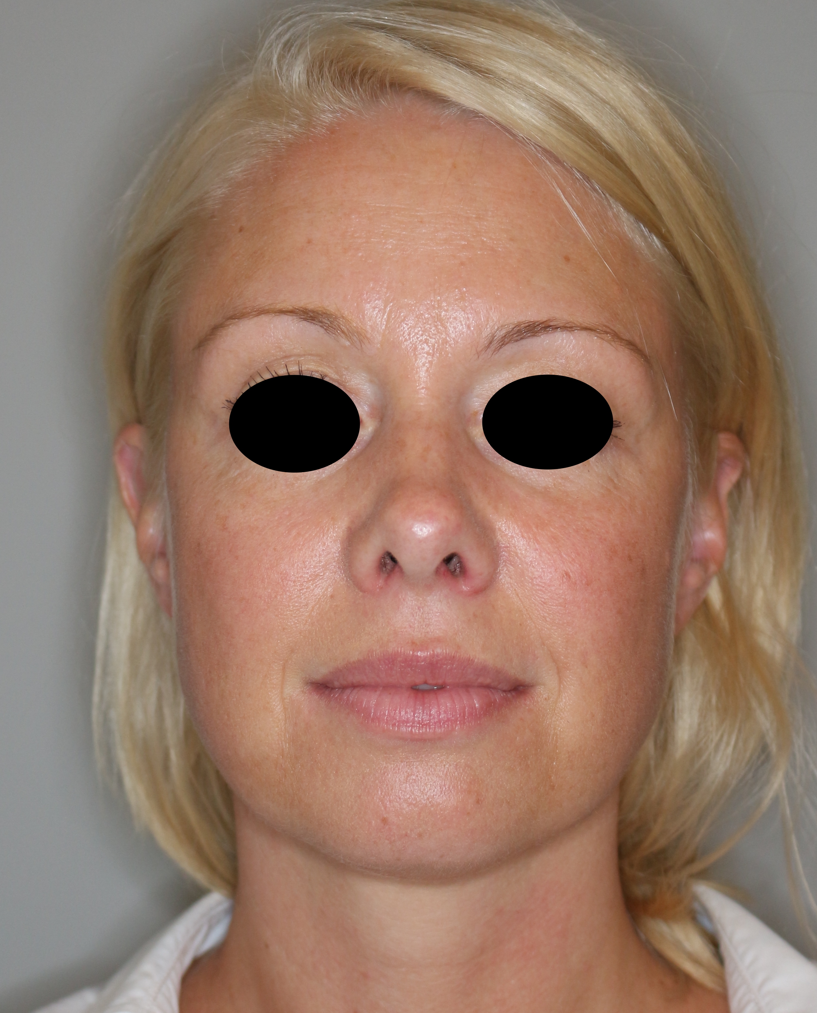 Hautunterspritzungen Before & After Patient #2238