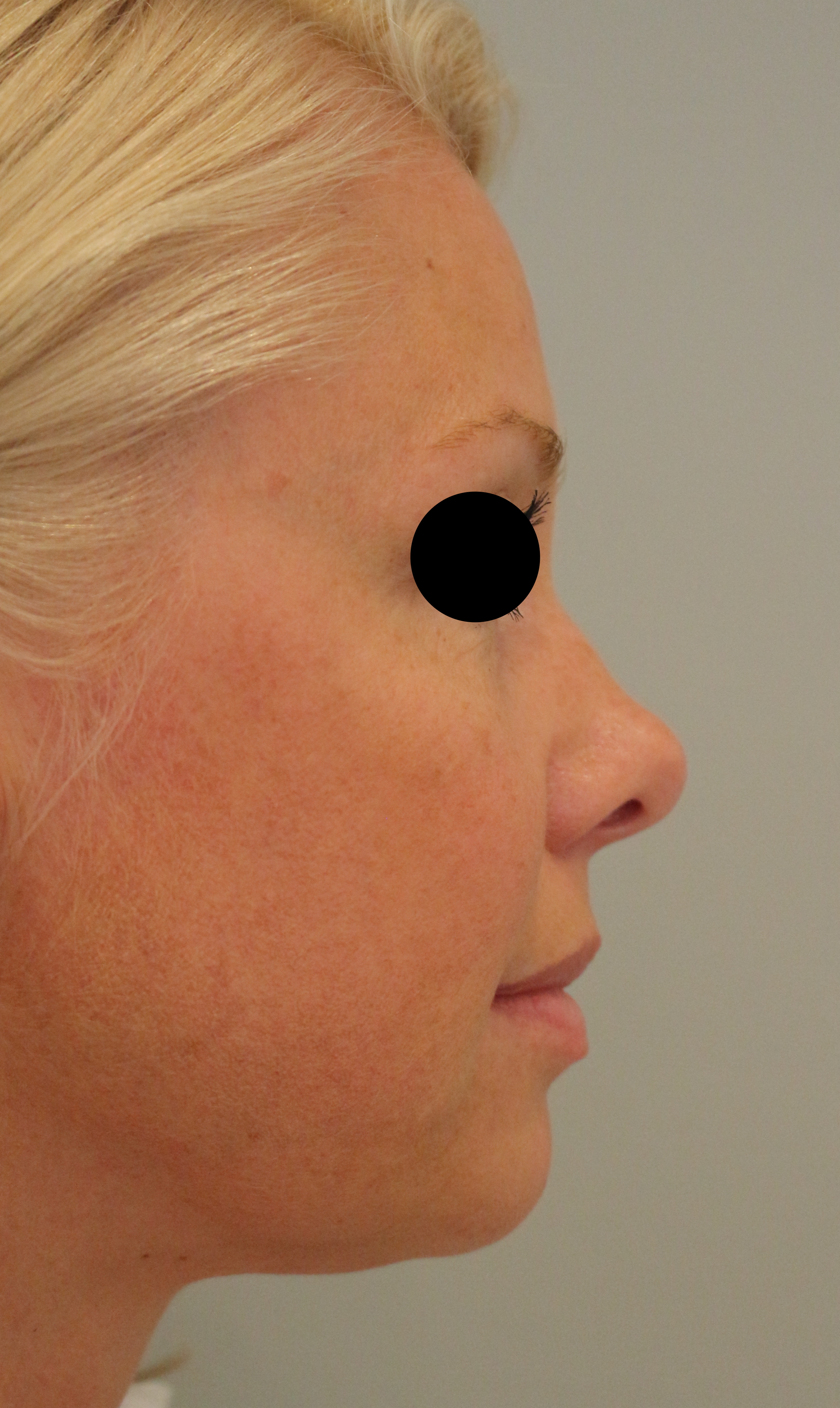 Hautunterspritzungen Before & After Patient #2238