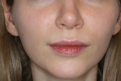 Lippenmodellierung Before & After Patient #2257