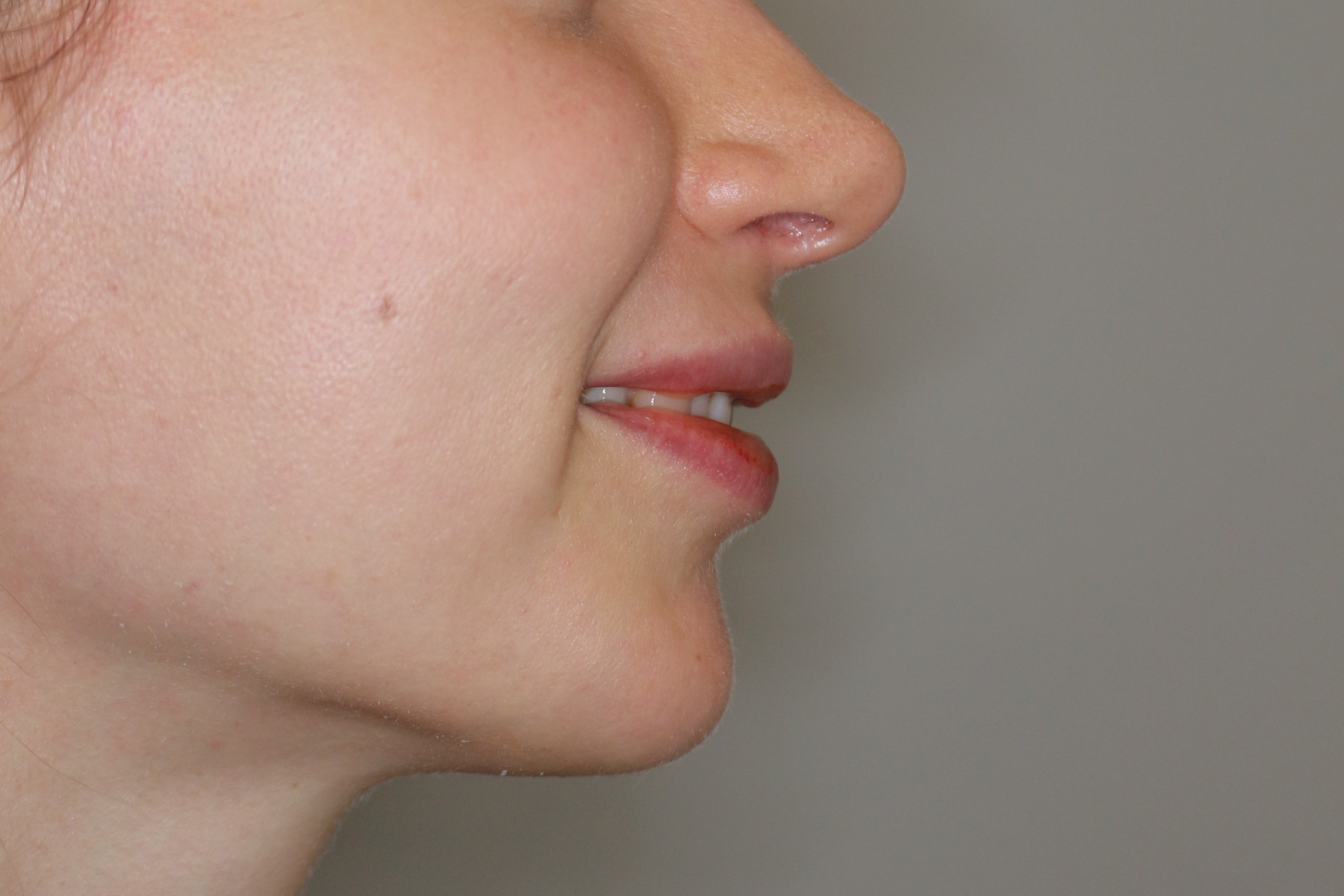 Lippenmodellierung Before & After Patient #2257