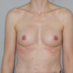 Brustvergrösserung (Eigenfetttransfer) Before & After Patient #2196
