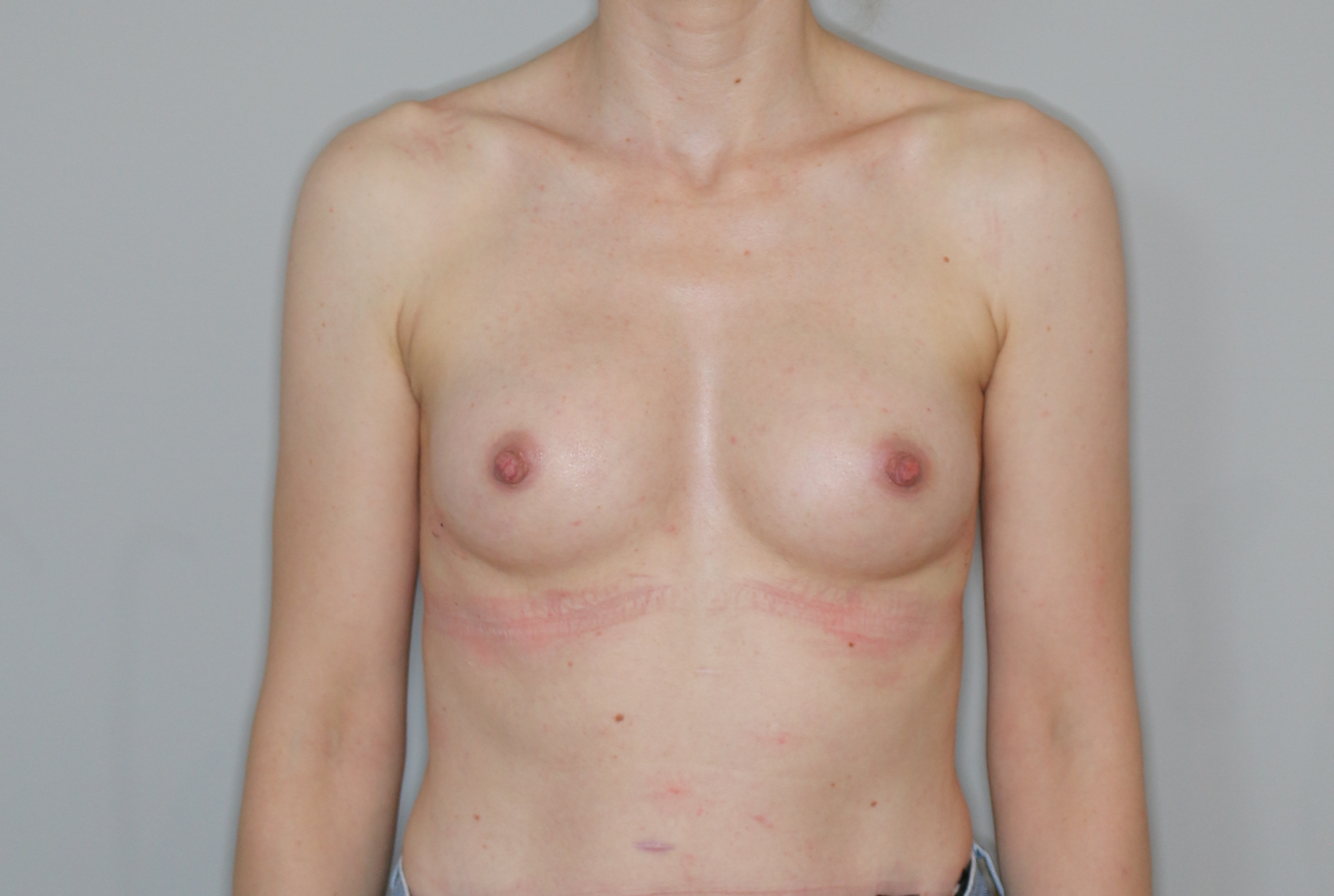 Brustvergrösserung (Eigenfetttransfer) Before & After Patient #2196