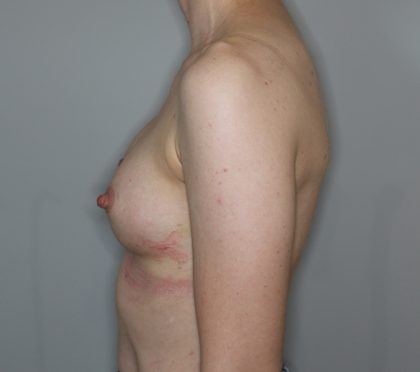 Brustvergrösserung (Eigenfetttransfer) Before & After Patient #2196