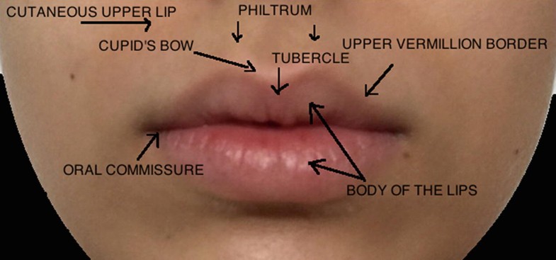 Lip Augmentation